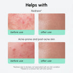 Redness Soothing Azelaic Acid Serum